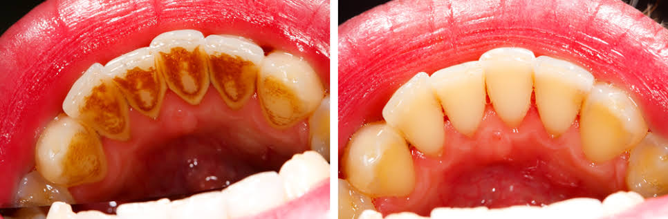 Dental Cleaning: How Often Should You Really Get It Done?