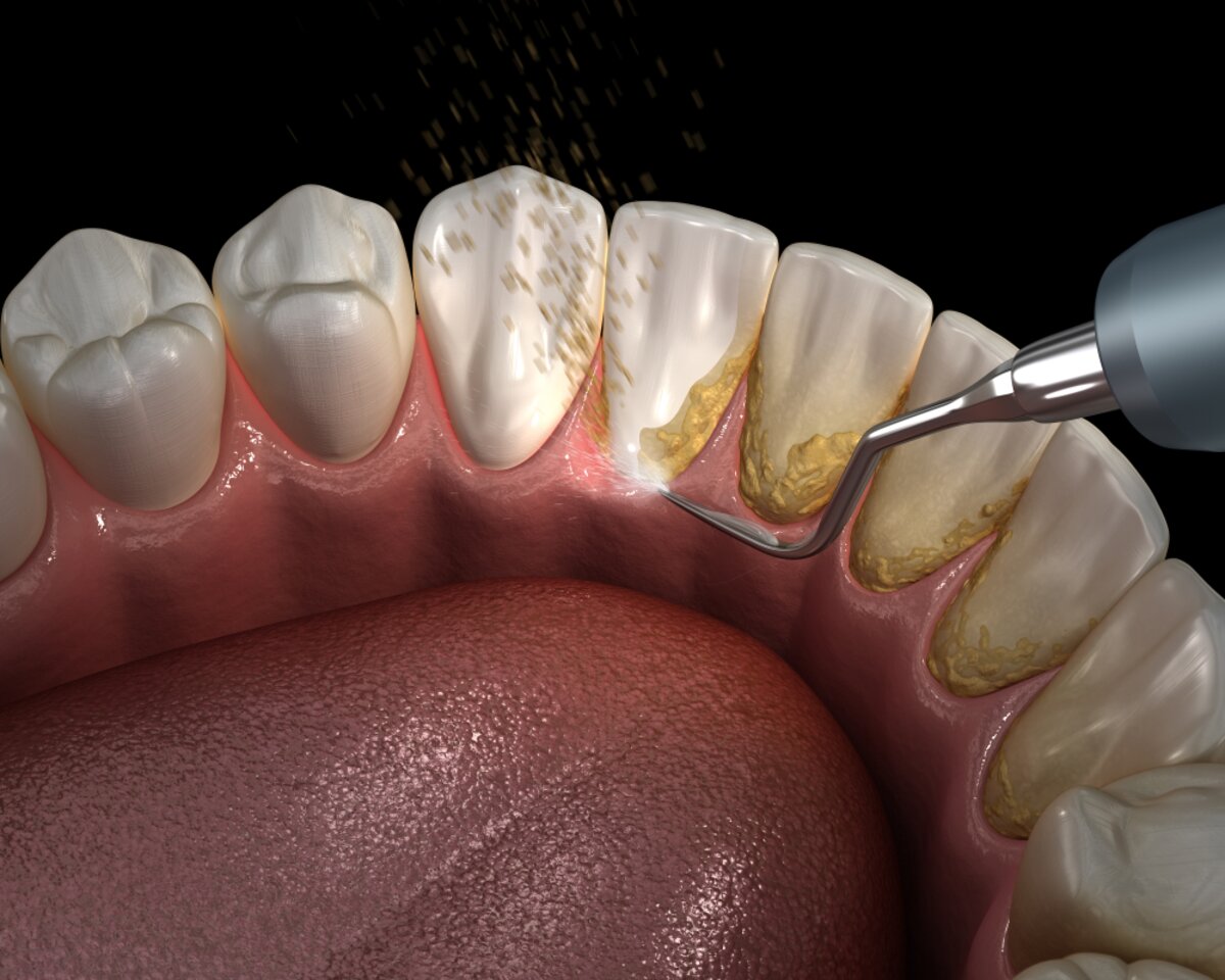 🦷 Dental Cleaning