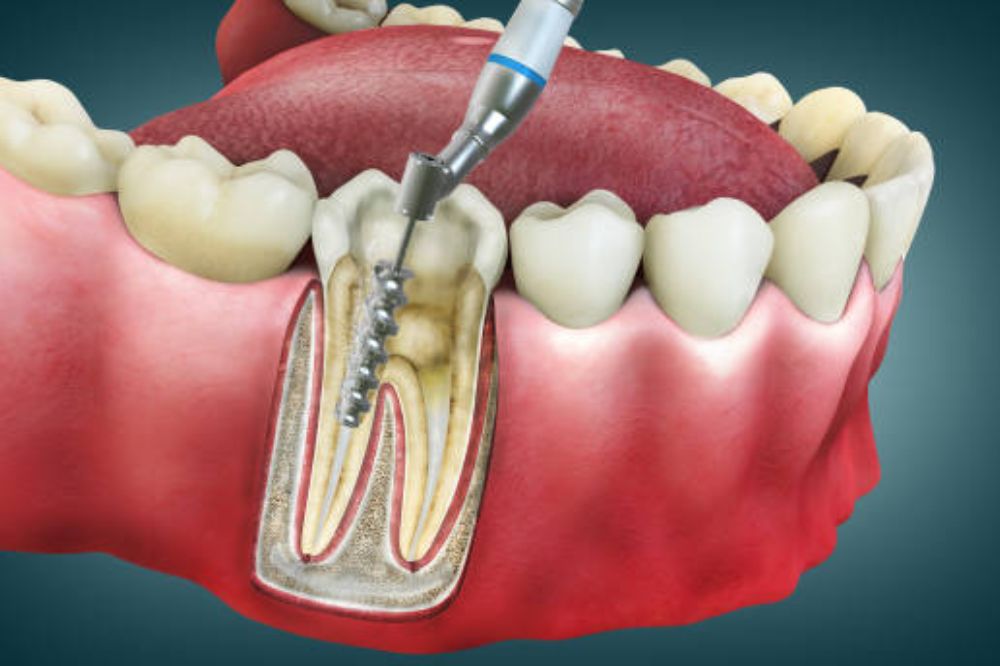 🦷 Root Canal Treatment