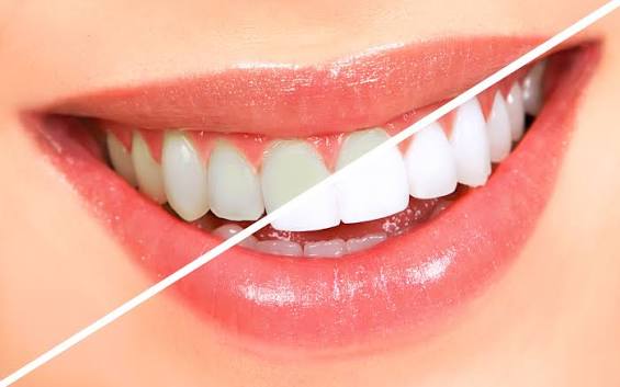 ✨ Teeth Whitening