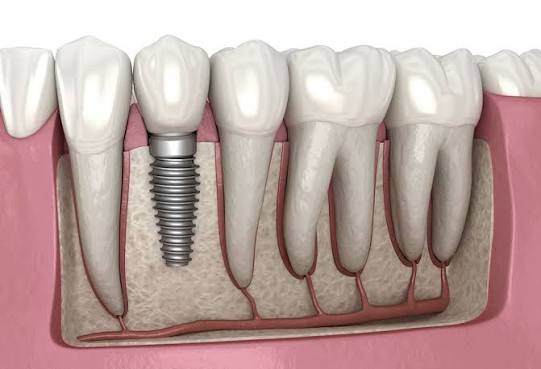 🦷 Dental Implants